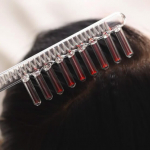 Дарсонвализация волос: показания, противопоказания и особенности процедуры